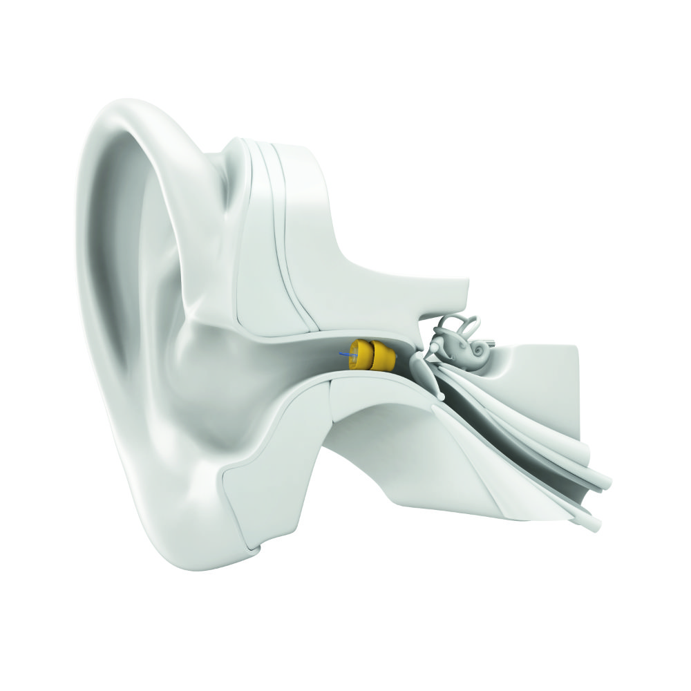 Side cutout of a model ear and ear canal, with Lyric carefully inserted to an ideal depth 4 mm from the eardrum.